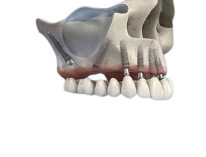 Rappresentazione 3D del bypass del seno mascellare con impianto pterigoideo inclinato: l'ancoraggio All-on-Full passa dall'osso alveolare (sabbia) all'osso basale (roccia)